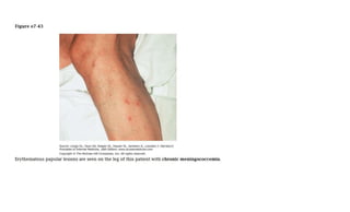 Atlas of Rashes Associated with Fever.pptx
