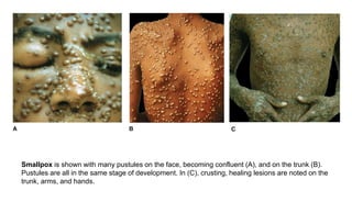 Pustular Rash Smallpox Atlas of Rashes Associated with Fever.pptx