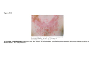 Atlas of Rashes Associated with Fever.pptx
