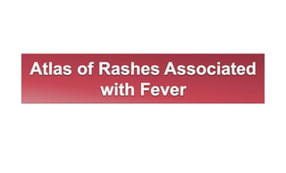 Given the extremely broad differential diagnosis, the
presentation of a patient with fever and rash often poses a
thorny d...