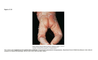 Atlas of Rashes Associated with Fever.pptx