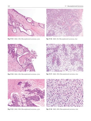 122
Fig. 17.13  (HE, 100×) Mucoepidermoid carcinoma, cystic
Fig. 17.14  (HE, 100×) Mucoepidermoid carcinoma, cystic
Fig. 1...