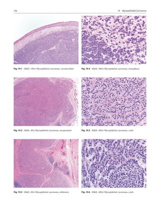 136
Fig. 19.3  (HE, 40×) Myoepithelial carcinoma, infiltrative
Fig. 19.4  (HE, 400×) Myoepithelial carcinoma, monophasic
F...