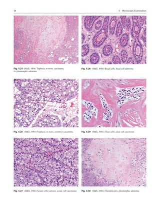 34
Fig. 5.25  (HE, 100×) Triphasic or more, carcinoma
ex pleomorphic adenoma
Fig. 5.26  (HE, 400×) Triphasic or more, secr...