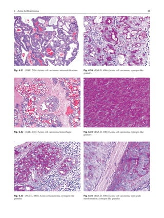43
Fig. 6.31  (HE, 200×) Acinic cell carcinoma, microcalcifications
Fig. 6.32  (HE, 200×) Acinic cell carcinoma, hemorrhag...