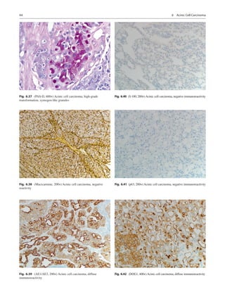 44
Fig. 6.37  (PAS-D, 600×) Acinic cell carcinoma, high-grade
transformation, zymogen-like granules
Fig. 6.38  (Mucicarmin...