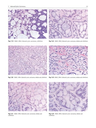 51
Fig. 7.19  (HE, 400×) Adenoid cystic carcinoma, cribriform
Fig. 7.20  (HE, 100×)Adenoid cystic carcinoma, tubular and c...
