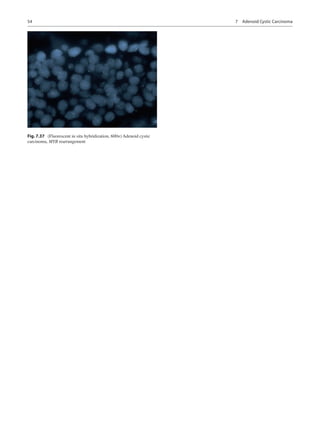 54
Fig. 7.37  (Fluorescent in situ hybridization, 600×) Adenoid cystic
carcinoma, MYB rearrangement
7  Adenoid Cystic Carc...