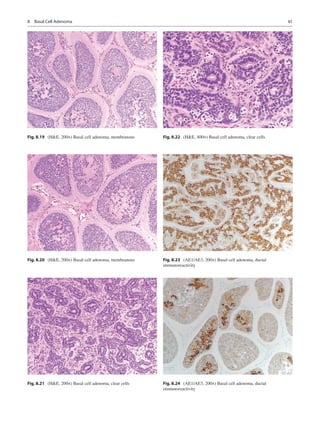 61
Fig. 8.19  (HE, 200×) Basal cell adenoma, membranous
Fig. 8.20  (HE, 200×) Basal cell adenoma, membranous
Fig. 8.21  (H...