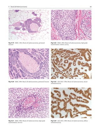 69
Fig. 9.19  (HE, 100×) Basal cell adenocarcinoma, perineural
invasion
Fig. 9.20  (HE, 200×) Basal cell adenocarcinoma, p...