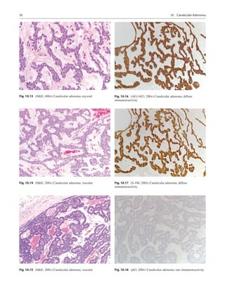 76
Fig. 10.13  (HE, 400×) Canalicular adenoma, myxoid
Fig. 10.14  (HE, 200×) Canalicular adenoma, vascular
Fig. 10.15  (HE...