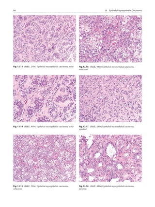 94
Fig. 13.13  (HE, 200×) Epithelial-myoepithelial carcinoma, solid
Fig. 13.14  (HE, 400×) Epithelial-myoepithelial carcin...