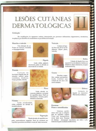LESÕES CUTÂNEAS
"
DERMATOLOGICAS
Definição
São modificações do tegumento cutâneo, determinadas por processos inflamatórios degenerativos, circulatórios,
neoplásicos,por distúrbios do metabolismo ou por defeito de formação.
Mancha e mácula
Uma alteração de cor.
Podem ser marrons, vermelhas
ou hipopigmentadas.
Pústula
Coleção de
leucócitos e líquido livre,de
tamanho variável (acne,
candidíase, disidrose,
herpes, psoríase, varicela).
Nódulo
Lesão arredondada,
sólida, podendo ser elevada ou
, situadana derme.
Pápula
Lesão sólida, palpável,
circunscrita, plana ou elevada ou
encurvada de cor variada.
Placa
Lesão elevada, cir-
cunscrita, palpável, e em geral
de superfície plana. Pode ser
descamativa, crostosa, quera-
tinizadaou macerada.
Vegetação
Pápula elevada,de superfícieirre-
gular, ocasionalmente sangrante. Pode ser recoberta por
superfície queratósica recebendo o nome de lesãoverrucosa.
Vesícula
Coleção de líqui-
do livre com até 0,5 cm de
diâmetro (líquen plano,
varicela).
Bolha
Coleção de líquido livre com
mais de 0,5cm de diâmetro (bolhas em
diabéticos, lúpus eritematoso, erupção
medicamentosa).
Crosta
Encobre a super-
fície cutânea previamente
lesada. Constitui uma
coleção de soro seco e de
restos celulares.
Edema
Acúmulo de
líquido no interstício.
Pele ficalisaebrilhante.
Escamas
Finas e estratificadas
Lâminas epidér-
nucas secas que se despren-
dem da superfície cutânea.
Tinha por dermatófitos,
xerose (pele seca). Escamas
em lâminas - descamação (escarlatina nas mãos e pés,
síndrome da pele escaldadaestafilocócica).
 