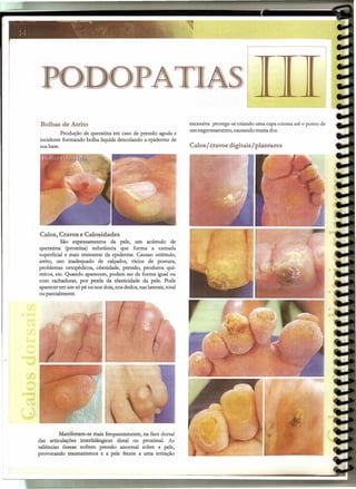 - -- ~~ -_ .•• .,~""4
- --:. . '-
]-+ -' -.'~~-
OPA
Bolhas de Atrito
Produção de queratina em caso de pressão aguda e
incidente formando bolha liquida descolando a epiderme de
suabase.
Calos, Cravos e Calosidades
São espessamentos da pele, um acúmulo de
queratina (proteína) substância que forma a camada
superficial e mais resistente da epiderme. Causas: estímulo,
atrito, uso inadequado de calçados, vícios de postura,
problemas ortopédicos, obesidade, pressão, produtos quí-
mícos, etc. Quando aparecem, podem ser de forma igual ou
com rachaduras, por perda da elasticidade da pele. Pode
aparecer em um só pé ou nos dois,nos dedos, nas laterais,total
ou parcialmente.
Manifestam-se mais frequentemente, na face dorsal
das articulações interfalângicas distal ou proximal. As
saliências ósseas sofrem pressão anormal sobre a pele,
provocando traumatismos e a pele frente a uma irritação
s
excessiva protege-se criando uma capa córnea até o ponto de
um engrossamento, causando muita dor.
Calos / cravos digitais / plantares
_'_-~-----"':":""="'--------=-----"""
 