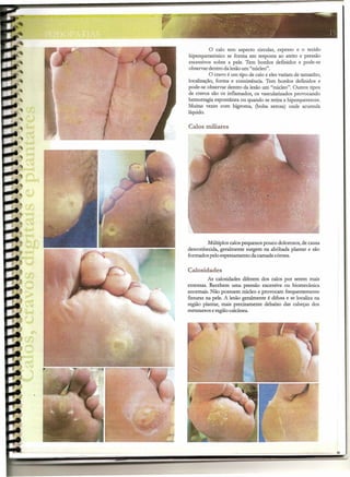 o calo tem aspecto circular, espesso e o tecido
hiperqueratósico se forma em resposta ao atrito e pressão
excessivos sobre a pele. Tem bordos definidos e pode-se
observar dentro da lesão um "núcleo".
O cravo é um tipo de calo e eles variam de tamanho,
localização, forma e consistência. Tem bordos definidos e
pode-se observar dentro da lesão um "núcleo". Outros tipos
de cravos são os inflamados, os vascularizados provocando
hemorragia espontânea ou quando se retira a hiperqueratose,
Muitas vezes com lúgroma, (bolsa serosa) onde acumula
líquido.
Calos miliares
Múltiplos calos pequenos pouco dolorosos, de causa
desconhecida, geralmente surgem na abóbada plantar e são
formados pelo espessamento da camada córnea.
Calosidades
As calosídades diferem dos calos por serem mais
extensas. Recebem uma pressão excessiva ou bíomecânica
anormais. Não possuem núcleo e provocam frequentemente
fissuras na pele. A lesão geralmente é difusa e se localiza na
região plantar, mais precisamente debaixo das cabeças dos
metatarsos eregião calcânea.
 