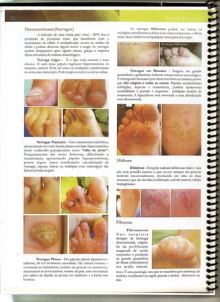 '"'11"""
- -"'- ...•~-- -,--- - ---"""';""- ","""
, ,
]8 '. "',::.
Dermatoviroses (Verrugas)
A infecção de uma célula pelo vírus - HPV; leva à
produção de proteínas virais que interferem com o
crescimento da célula. A multiplicação ocorre no núcleo da
célula e podem demorar alguns meses a surgir. As verrugas
podem desaparecer após alguns meses, graças à resposta
eficazcitotóxicado sistemaimunológico.
Verruga vulgar - É o tipo mais.comum e mais
clássico. É uma lesão pápulo-vegetante hiperceratósica de
tamanho variável.Pode ser única ou múltiplas e predominam
no dorso dasmãos epés.Pode surgirao redor ou sob asunhas.
Verrugas Plantares - Tem crescimento endofítico,
apresentando-se como lesões planas com halo hiperceratótico
sendo conhecido popularmente como "olho de peixe".
Frequentemente são muito dolorosas, dificultando a
deambulação, apresentando pápulas hiperqueratósicas,
pontos negros (vasos trombosados vascularização da
verruga), ásperas, únicas ou múltiplas com interrupção das
linhasnormais dapele.
Verrugas Planas - São pápulas planas ligeiramente
salientes, de cor levemente amarelada. São menos comuns e
resistentes ao tratamento, podem ser poucas ou numerosas,
disseminam-sepor coçadura, trauma da pele, auto-inoculação
por hábito de depilar as pernas em mulheres e a barba nos
homens.
As verrugas filiformes podem ser únicas ou
múltiplas,semelhantes a dedos e são observadas junto a olhos,
nariz, boca, barba ou em qualqueroutra parte do corpo.
Verrugas em Mosaico - Surgem em grande
quantidade e geralmente indicam compromisso imunológico.
A verruga em mosoaico por vezes recorrem no mesmo ponto,
que dão origem a todas as outras. Pápulas arredondadas
múltiplas, ásperas e ceratósicas, podem apresentar
sensibilidade à pressão e requerem múltiplas sessões de
tratamento. A hiperidrose está associada a uma distribuição
maisdisseminada.
Hidrose
Disidrose - Erupção sudoral súbita nas mãos e nos
pés com prurido intenso e que ocorre sempre em pessoas
instáveis emocionalmente, involuindo em uma ou duas
semanas e que são devidasà infiltração sudoral entre ascélulas
malpighianas.
Fibroma
Fibromatose
Uma neoplasia
benigna de etiologia
desconhecida, origina-
da da proliferação
exagerada de tecido
conjuntivo e produção
de grande quantidade
de fibras (fibroblastos)
nos tecidos subcutâ-
neos. Éuma patologia rara que se manifesta por presença de
nódulos localizados na região plantar e dedos, dolorosos ou
não.
 