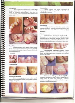 Onicogrifose
Distrofia que costuma afetar 6 hálux e outros dedos
dos pés, onde se observa um exagerado espessamento das
unhas, em formato de gancho, garra e muito dura. De
crescimento lento, pode ocorrer fraturas, dor e penetração nos
tecidos moles
Onicólise
Separação dista! ou lateral da unha do leito unguea!.
A parte separada aparece de cor esbranquiçada ou amarelada,
decorrente da presença de ar debaixo da unha e pelo acúmulo
de detritos, descamação.
Porpsoriase
Poronicornicose
ldiopática ou esculpida
Ocorre com a separação da unha do leito causada
pela excessiva eficiência de eliminar detritos que se acumulam
no espaço subunguea!.
Onicomadese
Queda completa das lâminas, decorrente da
separação proxima! da unhas, podendo ser reflexo de uma
doença local ou sistêmica.
Onicornicose
Infecção micótica que afeta toda ou parte da lâmina
ungueal, causada pelo ataque de fungos dermatófitos ou não,
também conhecida como tinha das unhas ou "tinea
ttnguium".
Achados cutâneos:
Onicomicose Distrófica Total (ODT) -
Caracterizada por uma evolução de todos os tipos, resultando
destruição total das unhas, com produção intensa de hiper-
queratose subunguea!, unhas estilhaçadas, descoladas, espes-
samento, mudança de coloração e costuma ser de vários anos.
Onicomicose Subungueal Distal Lateral
(OSDL) - A infecção tem início na borda livre (hiponíquio),
depois na zona dista! do leito, estendendo-se no sentido
proxima! até a matriz.
Onicornicose Subungueal Proximal (OSP) -
Inicia-se no eponíquio por baixo a partir de uma afetação do
extrato córneo da cutícula, com lesões sob a forma de
manchas esbranquiçadas na região da lúnula e depois
invadindo a lâmina no sentido dista!.
 