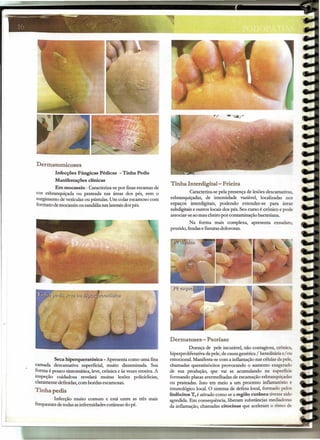 ----::=--
                                                 .       -
                                                     ---.--~~..:-
                                                       .•..
                                                      .. '-  - ,

   I (J                                  '.                     . ".
                                                                  '" ~.




            l)ernnato~coses
                      Infecções Fúngicas Pédicas         - Tinha Pedis
                      Manifestações   clínicas
                                                                             Tinha Interdigital- Frieira
                     Em mocassin - Caracteriza-se por finas escamas de
            cor esbranquiçada ou prateada nas áreas dos pés, sem o                     Caracteriza-se pela presença de lesões descamativas,
            surgimento de vesículas ou pústulas, Um colar escamoso com       esbranquiçadas, de intensidade variável, localizadas nos
            formato de mocassin ou sandália nas laterais dos pés.            espaços interdigitais, podendo estender-se para áreas
                                                                             subdigitais e outros locais dos pés. Seu curso é crônico e pode
                                                                             associar-se ao mau cheiro por contaminação bacteriana.
                                                                                       Na forma mais complexa, apresenta exsudato,
                                                                             prurido, fendas e fissuras dolorosas.




                                                                             Dermatoses - Psorlase
                                                                                       Doença de pele incurável, não contagiosa, crônica,
                                                                             hiperproliferativa da pele, de causa genética / hereditária e/ ou
                     Seca hiperqueratósica - Apresenta como uma fina         emocional. Manifesta-se com a inflamação nas célulasda pele,
            camada descamativa superficial, muito disseminada. Sua           chamadas queratinócitos provocando o aumento exagerado
            forma é pouco sintomática, leve, crônica e às vezes erosiva. A   de sua produção, que vai se acumulando na superfície
            inspeção cuidadosa revelará muitas lesões policiclicias,         formando placas avermelhadas de escamação esbranquiçadas
            claramente definidas, com bordas escamosas.                      ou prateadas. Isso em meio a um processo inflamatório e
                                                                             imunológico local. O sistema de defesa local, formado pelos
            Tinhapedis
                                                                             linfócitos T, é ativado como se a região cutânea tivesse sido
                     Infecção muito comum e está entre as três mais          agredida. Em consequência, liberam substâncias mediadoras
            frequentes de todas as inferrnidades cutâneas do pé.             da inflamação, chamadas citocinas que aceleram o ritmo de
 
