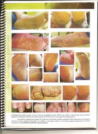 --       .","   -:-o:   ""'~   .•• ~-:   ~   -       J   --=------=-~
                                                                              .                              :;           .
                                                                    ",.                                                                          -
                                                                   :~.                                                                           ~ I




proliferação das células da pele. A pele do doente de psoriase produz 35000 novas células a cada dia para cada centímetro
quadrado. A duração normal do ciclo celular da pele é de 311 horas, mas se reduz para 36 na pele psoriática.
          As alterações ungueais por psoríase são: Depressão puntiforme, onicólise, manchas de óleo, hiperceratose subungueal,
distorçâo da placa ungueal, hemorragias em estilhaço e paroniquia crônica. As anomalias ungueais apresentam-se em duas
categorias: com evolução intermitente e as permanentes.
 