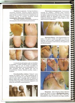 ~,-
                           -                           . ..... -
                                                             .     ""

    --.   -                                   -.            -      ..•   ~
_                                         ~        _                     ><011'-




                        Puntiforme OU punctata - Etiologia hereditária e,                    Poroceratose ou poroqueratose - A poroceratose
              autossômica dominante. Apresenta pequenas depressões,                pontuada são múltiplas e diminutas lesões ceratósicas
              erosões, perda extrema da camada externa hiperqueratósica na         pontuadas envoltas por halo branco elevado e fino, presentes
              planta dos pés ou artelhos. As lesões tem a aparência de um          nas palmas e plantas dos pés. Possui núcleo e se localizam
              colarinho circular. As bactérias causadoras incluem                  geralmente debaixo de superfícies que suportam o peso
              Corinebactéria eMicrococcus Sedentarius.                             (cabeça dos metatarsos e calcâneo). Podem surgir em outras
                        Pela manhã a aparência é avermelhada, tornando-se          regiões do pé (arcolongitudinal).
              esbranquiçada no decorrer do diapela ação da sudorese.




                                                                                            Queratoma Plantar - Lesão hiperqueratósica com
                                                                                   núcleo e em geral se localiza nas regiões ou zonas que
                                                                                   suportam o peso do corpo e geralmente embaixo de uma
                                                                                   cabeça de um metatarso e muito doloroso. Tem aparência de
                                                                                   um chifre de carneiro.




                        A ceratodermia palmoplantar pode ser hereditária
              ou secundária. O padrão hereditário pode ser dominante,
              recessivo e ligado ao sexo. As formas secundárias de
              ceratodermia palmoplantar ocorrem principalmente com a
              sífilis secundária, tinea pedis, infecção pelo vírus da
              imunodeficiência humana, climatério, psoríase, trauma e
              neoplasias.

                         Ceratodermia Rara - Ainhum - "Ainhum", termo
              angolano que significa "serrar" é uma ceratodermia que se
              caracteriza pela formação de anéis fibrosos geralmente ao
              redor do quinto dedo. A patologia pode ser unilateral ou
              bilateral. Atinge todas as raças, sendo mais freqüente no sexo
              masculino da raça negra. É de crescimento progressivo com
              edema, dor, odor fétido e material supurativo.




                                                                                            Hanseníase - Mal de Hansen, doença infecciosa
                                                                                   causada pelo Bacilo de Hansen (M)'cobacterium 19prae),
                                                                                   agente patógeno que acomete a pele, olhos e nervos das
                                                                                   extremidades do corpo. É conhecida como lepra, morféia,
 
