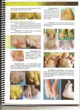 mal-de-Lázaro, mal-da-pele ou mal-do-sangue. As lesões                     Comptodactilia - É
são chamadas de lepromas ou hansenomas.                           uma deformidade do "dedo
                                                                  em martelo concêntrico" ou
                                                                  flexão permanente do "dedo
                                                                  em pescoço de cisne", um
                                                                  desvio posicional do segundo
                                                                  dedo, onde este se desvia para
                                                                  baixo do hálux.


Anomalias/ malforrnações genéticas
                                                                           Polidactilia - Esta anomalia é o oposto da ausência
          Defeito congênito em que a pessoa já nasce com a
                                                                  do 5° dedo, ou seja, a pessoa nasce com mais de 'cinco dedos no
deformidade. A origem destas malformações está classificada
                                                                  pé. Éhereditária.
em três estágios: Genético, Embriológica e Fetal. Defeitos nos
dedos dos pés são muito freqüentes e variados e dentre eles
destacamos:
          Sindactilia - É a união de .dois ou mais dedos
contínuos em uma única cobertura cutânea,




                                          Clinodactilia - Uma
                              anomalia do 5° dedo do pé,
                              também conhecido            como
                               "digiti quinti uarus" ou 5° dedo
                              varo congênito em que o 5°
                              dedo se sobrepõe no 4°.



         Braquimatatarso      - Uma deformidade       onde
acontece o encurtamento do quarto metatarsofalângico. Pode
ocorrer em qualquer outro metatarso, mas no 4° é mais
comum. Pode ser unilateral ou bilateral.
                                                                            Pé fendido ou ectrodactilia - Uma anomalia da
                                                                  porção anterior do pé,' onde se observa uma aplasia dos
                                                                  metatarsianos centrais sem os dedos correspondentes. O pé
                                                                  possui uma chanfradura, ou seja, aplainamento que chega até a
                                                                  porção média do pé.




                                                                                                                                        .
                                                          -               -               --   -        -                   ""'!:--~-   -
 