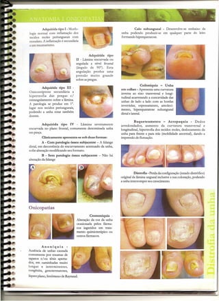 Adquirida tipo I - Morfo-                                   Calo subungueal - Desenvolve-se embaixo da
logia normal com inflamação dos                              unha podendo produzir-se em qualquer parte do leito
tecidos moles periungueais com                               formando hiperqueratose.
exsudato.A inflamação é secundária
a um traumatismo.


                                            Adquirida tipo
                                  II - Lâmina encurvada ou
                                  angulada a nível frontal
                                  (ângulo de 90°). Esta
                                  angulação produz uma
                                  pressão muito grande
                                  sobre as pregas.
                                                                             Coiloníquia - Unha
          Adquirida tipo III -
                                                             em colher - Apresenta uma curvatura
Onicocriptose    secundária a                                inversa ao eixo transversal e longi-
hipertrofia   das pregas c/                                  tudinal acarretando a concavidade das
estrangulamento sobre a lâmina.
                                                             unhas de lado a lado com as bordas
A patologia se produz em 1°.
                                                             invertidas, espessamento, amoleci-
lugar nos tecidos periungueais,
                                                             mento, hiperqueratose subungueal
podendo a unha estar também                                  distal e lateral.
doente.
                                                                      Baqueteamento          - Acropaquia       - Dedos
        Adquirida tipo IV - Lâmina severamente               arredondados,     aumento da curvatura transversal e
encurvada no plano frontal, comumente denominada unha        longitudinal, hipertrofia dos tecidos moles, deslocamento da
empmça.                                                      unha para frente e para trás (mobilidade anormal), dando a
         Clinicamente apresenta-se sob duas formas:          impressão de flutuação.
          A - Com patologia óssea subjacente - A falange
distal, em decorrência do encurvamento acentuado da unha,
sofre alteração modificando seu formato.
          B - Sem patologia óssea subjacente - Não há
alteração da falange



                                                                       Distrofia - Perda da configuração (estado distrófico)
                                                             original da lâmina ungueal inclusivea sua coloração, podendo
                                                             a unha interromper seu crescimento.




Onicopatias
                                            Cromoníquia -
                                  Alteração da cor da unha
                                  ocasionada pelos fárma-
                                  cos ingeridos em trata-
                                  mento quimioterápico ou
                                  outros fármacos.


         Anoníquia
Ausência de unhas causada
comumente por traumas de
sapatos e/ou tênis aperta-
dos, em caminhadas muito
longas e intermitentes,
congênita, genotermatoses,
liquen plano, fenômeno de Raynaud.



                                                                                                                               --
                                                                   -             ---     -        _               -   "-s-~
 