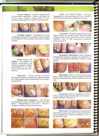 Fraturas Ungueais - As fraturas ungueais podem                    Linhas e ou Sulcos de Beau - Interrupção
ser transversais, longitudinais e oblíquas, ocasionadas por       temporária das células germinativas da unha e quando a
traumas, anemia, infecções crônicas, déficit de ferro,            matriz volta à sua produção normal aparecem os sulcos.
exposição a agentes químicos, fungos e traumas repetitivos.




                                                                            Leuconíquia - Alteração na pigmentação da placa
         Involução Ungueal - Encurvamento da unha                 ungueal causadas por inúmeros fatores. Tipos: leuconíquia
modificando seu formato. O encurvamento ocorre em relação         verdadeira (branco total), subtotal (2/3 da unha é branca),
à profundidade do leito nas margens distais, laterais e mediais   hereditária, Linha de Mees (transversas), puntiformes
da lâmina.                                                        (pequenas manchas).




                                                                            Macroníquia / Microníquia - Unhas consideradas
                                                                  demasiadamente grandes ou pequenas em comparação com
                                                                  as outras unhas, geralmente associadas a traumas e origem
         Hemorragia        em
                                                                  genética.
estilhaço - São causadas por
coágulos microscópicos     que
danificam os pequenos capilares
(microembolia) sob as unhas.
Causas mais comuns são os trau-
matismos.


         Hematoma      - Trauma sofrido na lâmina,                         Melaloníquia - Refere-sea uma faixamarronou negra
                                                                  dentro da lâmina ungueal que surge da produção de melanina
apresentando hematoma, causando dor e acúmulo de sangue
                                                                  produzidapelosmelanócitosquesefixamna matriz.Comumna raça
sob a unha, podendo ocorrer o descolamento ou até mesmo a         negra.
queda da lâmina.




                                                                           Onicoatrofia - Perda da configuração e coloração
                                                                  da lâmina ungueal, seguida da interrupção do crescimento,
                                                                  redução da largura e comprimento.
          Hiperqueratose subungueal - Uma anomalia
caracterizada pelo acúmulo de detritos córneos sob a unha.
Produz o estrangulamento do leito, altera o formato, a
coloração, os tecidos ao redor da unha e causa dor.


                                                                           Onicocauxia - Unha hipertrófica Uma anomalia do
                                                                  espessamento da unha, que aumenta a partir da borda livre e
                                                                  ocorre principalmente no hálux acompanhada de uma cor
                                                                  amarelo/ amarronzada.
 