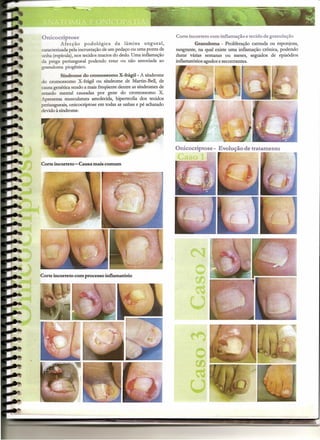 Onicocriptose                                                  Corte incorreto com inflamação e tecido de granulação
          Afecção podológica        da lâmina ungueal,                  Granuloma - Proliferação carnuda ou esponjosa,
caracterizadapela incrustação de um pedaço ou uma ponta de     sangrante, na qual existe uma inflamação crônica, podendo
unha (espícula),nos tecidos macios do dedo. Uma inflamação     durar várias semanas ou meses, seguidos de episódios
da prega periungueal podendo estar ou não associada ao         inflamatórios agudos e recorrrentes.
granuloma piogênico.
          Síndrome do cromossomo X-frágil- A síndrome
do cromos somo X-frágil ou síndrome de Martin-Bell, de
causa genética sendo a mais freqüente dentre as síndromes de
retardo mental causadas por gene do cromos somo X.
Apresenta musculatura amolecida, hipertrofia dos tecidos
periungueais, onicocriptose em todas as unhas e pé achatado
devido à síndrome.




                                                               Onicocriptose - Evolução de tratamento

Corte incorreto - Causa mais comum




                                                                         o
                                                                         00
                                                                         ~

                                                                     U
                                                                     -              ~            -   -              ~--    ...•
 