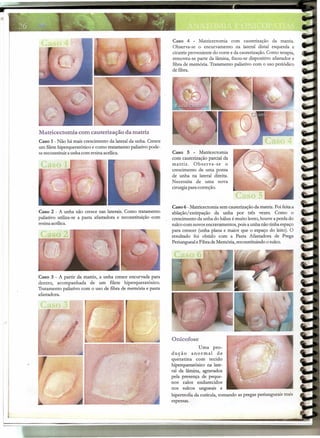 -----------r-


                                                                 Caso 4 - Matricectomia com cauterização da matriz.
                                                                 Observa-se o encurvamento na lateral distal esquerda e
                                                                 cicatriz proveniente do corte e da cauterização. Como terapia,
                                                                 removeu-se parte da lâmina, fixou-se dispositivo afastador e
                                                                 fibra de memória. Tratamento paliativo com o uso periódico
                                                                 de fibra.




 Matricectomia       com cauterização da matriz
 Caso 1 - Não há mais crescimento da lateral da unha. Cresce
 um filete hiperqueratósico e como tratamento paliativo pode-
 se reconstituir a unha com resina acrilica.                     Caso 5 - Matricectomia
                                                                 com cauterização parcial da .
                                                                 matriz.    Observa-se     o
                                                                 crescimento de uma ponta
                                                                 de unha na lateral direita.
                                                                 Necessita de uma nova
                                                                 cirurgiapara correção.



                                                                 Caso 6 - Matricectomia sem cauterização da matriz. Foi feita a
. Caso 2 - A unha não cresce nas laterais. Como tratamento       ablaçãoIextirpação da unha por três vezes. Como o
  paliativo utiliza-se a pasta afastadora e reconstituição com   crescimento da unha do hálux é muito lento, houve a perda do
  resina acrilica.                                               sulco com novos encravamentos, pois a unha não tinha espaço
                                                                 para crescer (unha plana e maior que o espaço do leito). O
                                                                 resultado foi obtido com a Pasta Mastadora de Prega
                                                                 Periungueal e Fibra de Memória, reconstituindo o sulco.




Caso 3 - A partir da matriz, a unha cresce encurvada para
dentro, acompanhada de um filete hiperqueratósico.
Tratamento paliativo com o uso de fibra de memória e pasta
afastadora.




                                                                 Onicofose
                                                                               Uma pro-
                                                                 dução      anormal      de
                                                                 queratina com tecido
                                                                 hiperqueratósico na late-
                                                                 ral da lâmina, agravados
                                                                 pela presença de peque-
                                                                 nos calos endurecidos
                                                                 nos sulcos ungueais e
                                                                 hipertrofia da cutícula, tornando as pregas periungueais mais
                                                                 espessas.
 