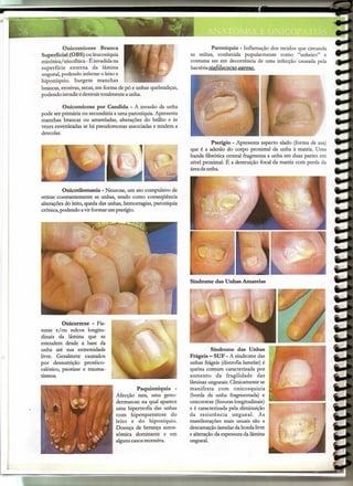 "I1ll1U111




                       Onicomicose       Branca                                         Paroniquia - Inflamação dos tecidos que circunda
             Superficial (OBS) ou leuconíquia                                 as unhas, conhecida popularmente como "unheiro" e
             micótica/ tricofítica - Éinvadida na                             costuma ser em decorrência de uma infecção causada pela
             superfície externa da lâmina                                     bactéria stafilococus aureus.
             ungueal, podendo infectar o leito e
             hiponíquio. Surgem manchas
             brancas, erosivas, secas, em forma de pó e unhas quebradiças,
             podendo invadir e destruir totalmente a unha.

                       Onicomicose por Candida - A invasão da unha
             pode ser primária ou secundária a uma paroníquia. Apresenta
             manchas brancas ou amareladas, alterações do brilho e às
             vezes esverdeadas se há pseudomonas associadas e tendem a
             descolar.
                                                                                        Pterigio - Apresenta aspecto alado (forma de asa)
                                                                              que é a adesão do corpo proximal da unha à matriz. Uma
                                                                              banda fibrótica central fragmenta a unha em duas partes em
                                                                              nível proximal. É a destruição focal da matriz com perda da
                                                                              área da unha.



                        Onicotilomania - Neurose, um ato compulsivo de
              retirar constantemente as unhas, tendo como conseqüência
             ,alterações do leito, queda das unhas, hemorragias, paroníquia
              crônica, podendo a vir formar um pterígio.




                                                                              Sindrome das Unhas Amarelas




                       Onicorrexe - Fis-
             suras e/ou sulcos longitu-
             dinais da lâmina que se
             estendem desde a base da
             unha até sua extremidade                                                   Sindrome das Unhas
             livre. Geralmete causados                                        Frágeis - SUF - A síndrome das
             por desnutrição protéico-                                        unhas frágeis (distrofia lamelar) é
             calórico, psoríase e trauma-                                     queixa comum caracterizada por
             tismos.                                                          aumento da fragilidade das
                                                                              lâminas ungueais. Clinicamente se
                                                        Paquioniquia -        manifesta com onicosquizia
                                               Afecção rara, uma geno-        (borda da unha fragmentada) e
                                               dermatose na qual aparece      onicorrexe (fissuraslongitudinais)
                                               uma hipertrofia das unhas      e é caracterizada pela diminuição
                                               com hiperqueratose do          da resistência      ungueal. As
                                               leito e do hiponíquio.         manifestações mais usuais são a
                                               Doença de herança autos-       descamação lamelar da borda livre
                                               sômica dominante e em          e alteração da espessura da lâmina
                                               alguns casos recessiva.        ungueal.
 