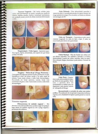 Traumas Ungueais - São lesões sofridas pelas                   Unha Dobrada - Esta deformidade remodela a
unhas, mais precisamente na matriz, causadas por queda de       matriz da unha e é causada pela pressão do sapato durante um
objetos, topadas, pisadas, futebol, caminhada intermitente,     longo período de tempo. Um ou ambos os bordos se dobram
etc., podendo causar a morte de células matriciais deformando   em um ângulo de 90°.
a unha.




                                                                         Unha em Trompete - Caracteriza-se pelo encur-
                                                                vamento exagerado da unha de lado a lado. A unha vai
                                                                encurvando para dentro até a parte distal,




          Traquioníquia - Unha rugosa - Apresenta super-
fície rugosa, áspera, acinzeritada, com aspecto de que foram
polidas com areia.                                                         Unhas Postiças - Elas são fixadas nas unhas com
                                                                um adesivo específico. Sua utilidade é limitada e as lesões,
                                                                desencadeiam a queda das unhas, onicólise, lesão na super-
                                                                fície, infecção fúngica, bacteriana e pode alterar o formato da
                                                                lúnula ..




          Tungíase - Bicho-de-pé (Tunga Penetrans) -
Uma espécie de pulga que penetra na pele, geralmente nos pés.
Identifica-se como um ponto escuro e ao redor sinais de
                                                                           Unha Torta - Caracte-
eritema. Causa muita coceira e exibe lesão dermatológica.
                                                                riza-se pela deformidade da falan-
Encontrada em locais arenosos, currais, locais com
                                                                ge distal, de causa genética. Neste
excremento de gatos e cães. Causa muita coceira e exibe lesão
                                                                caso, o paciente        deve ser
dermatológica.
                                                                encaminhado ao médico para um
                                                                diagnóstico mais preciso, através
                                                                de radiografia da falange.

                                                                          Reconstituição e correção da unha com resina
                                                                acrilica - Procedimento de recuperação temporária da lâmina
                                                                ungueal, com a finalidade de reparar a perda parcial ou total da
                                                                unha.


Tumores ungueais
          Fibroceratoma da unídade ungueal -          São
descritos como dermatofibromas e podem surgir em qualquer
lugar dentro da unidade ungueal ou sob a prega ungueal e
geralmente são esféricos.




                                                                                   -   _._--    -       -                 ~ ~~---
 
