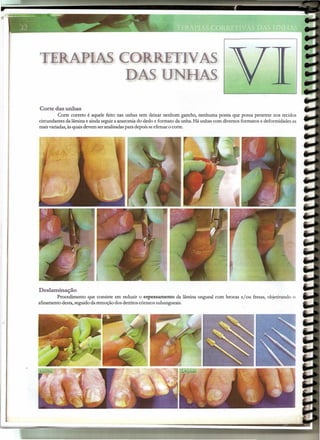 TERAPIAS CO    TIVAS
          DAS UNHAS

Corte das unhas
          Corte correto é aquele feito nas unhas sem deixar nenhum gancho, nenhuma ponta que possa penetrar nos tecidos
circundantes da lâmina e ainda seguir a anatomia do dedo e formato da unha. Há unhas com diversos formatos e deformidades as
mais variadas, às quais devem ser analisadas para depois se efetuar o corte.




Deslaminação
         Procedimento que consiste em reduzir o espessamento da lâmina ungueal com brocas e/ou fresas, objetivando o
afinamento desta, seguido da remoção dos detritos córneos subungueais.
 
