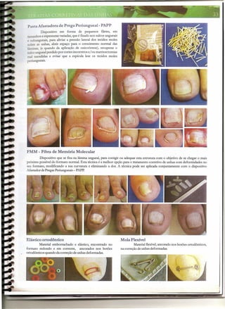 Pasta Afastadora de Prega Periungueal- PAPP
         Dispositivo em forma de pequenos filetes, em
tamanhos e espessuras variadas, que é fixado nos sulcos ungueais
e subungueais, para aliviar a pressão lateral dos tecidos moles
sobre as unhas, abrir espaço para o crescimento normal das
lâminas, (e quando da aplicação de onicoórtese), recuperar o
sulcoungueal perdido por cortes incorretos e/ ou matricectomias
mal sucedidas e evitar que a espícula lese os tecidos moles
periungueais.




FMM - Fibra de Memória Molecular
        Dispositivo que se fixa na lâmina ungueal, para corrigir ou adequar esta estrutura com o objetivo de se chegar o mais
próximo possível do formato normal. Esta técnica é a melhor opção para o tratamento corretivo de unhas com deformidades no
seu formato, modificando a sua curvatura e eliminando a dor. A técnica pode ser aplicada conjuntamente com o dispositivo
Mastador de Pregas Periungueais - PAPP.




Elástico ortodôntico                                               Mola Flexível
         Material emborrachado e elástico, encontrado no                    Material flexível,ancorado nos botões ortodônticos,
formato redondo e em corrente, ancorados nos botões                na correção de unhas deformadas.
ortodônticos quando da correção de unhas deformadas.




                                                       --
                                                ..:.        ~            -   -       - --   - ~    --    -               -   -,-
 