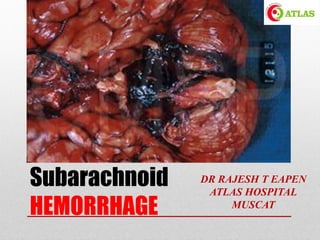 Subarachnoid
HEMORRHAGE
DR RAJESH T EAPEN
ATLAS HOSPITAL
MUSCAT
 