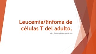 Leucemia/linfoma de
células T del adulto.
MR1 Yesenia Huerta Collado
 