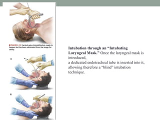 Intubation through an “Intubating
Laryngeal Mask.” Once the laryngeal mask is
introduced,
a dedicated endotracheal tube is inserted into it,
allowing therefore a “blind” intubation
technique.
 