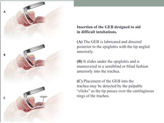 Insertion of the GEB designed to aid
in difficult intubations.
(A) The GEB is lubricated and directed
posterior to the epiglottis with the tip angled
anteriorly.
(B) It slides under the epiglottis and is
maneuvered in a semiblind or blind fashion
anteriorly into the trachea.
(C) Placement of the GEB into the
trachea may be detected by the palpable
“clicks” as the tip passes over the cartilaginous
rings of the trachea.
 