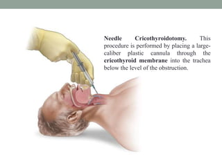 Needle Cricothyroidotomy. This
procedure is performed by placing a large-
caliber plastic cannula through the
cricothyroid membrane into the trachea
below the level of the obstruction.
 