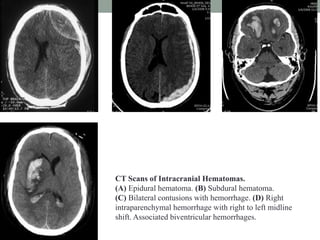 CT Scans of Intracranial Hematomas.
(A) Epidural hematoma. (B) Subdural hematoma.
(C) Bilateral contusions with hemorrhage. (D) Right
intraparenchymal hemorrhage with right to left midline
shift. Associated biventricular hemorrhages.
 