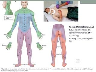 Spinal Dermatomes. (A)
Key sensory points by
spinal dermatomes. (B)
Assessing
sensory response–nipple,
T4.
Adapted from the American Spinal Injury Association: International Standards for Neurological Classification of Spinal Cord Injury, revised 2002. Chicago,
IL: American Spinal Injury Association; 2002.
 
