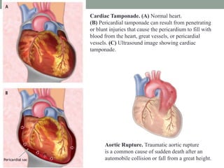 Cardiac Tamponade. (A) Normal heart.
(B) Pericardial tamponade can result from penetrating
or blunt injuries that cause the pericardium to fill with
blood from the heart, great vessels, or pericardial
vessels. (C) Ultrasound image showing cardiac
tamponade.
Aortic Rupture. Traumatic aortic rupture
is a common cause of sudden death after an
automobile collision or fall from a great height.
 