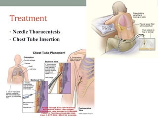 Treatment
• Needle Thoracentesis
• Chest Tube Insertion
 