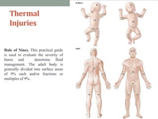 Thermal
Injuries
Rule of Nines. This practical guide
is used to evaluate the severity of
burns and determine fluid
management. The adult body is
generally divided into surface areas
of 9% each and/or fractions or
multiples of 9%.
 