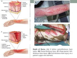Depth of Burns. (A) S hallow partialthickness burn
injury. (B) Partial-thickness burn. (C) Deep partial, full-
thickness burn injury. (D) Full-thickness burn injury on a
patient’s upper arm and back.
 