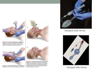 laryngeal mask airway
laryngeal tube airway
 