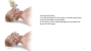 Inserting Oral Airway.
A. In this technique, the oral airway is inserted upside down
until the soft palate is encountered.
B. The device is then rotated 180 degrees and slipped into
place over the tongue.
07/09/2022 10
 