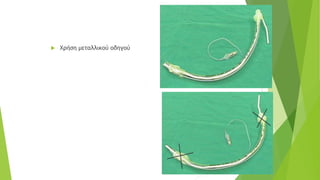  Χρήση μεταλλικού οδηγού
 