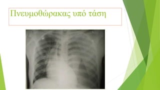 Πνευμοθώρακας υπό τάση
 