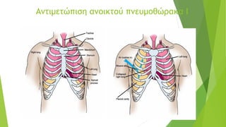 Αντιμετώπιση ανοικτού πνευμοθώρακα Ι
 