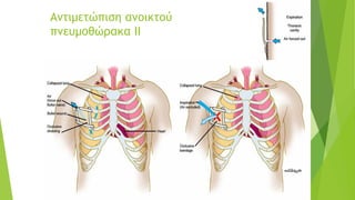 Αντιμετώπιση ανοικτού
πνευμοθώρακα ΙΙ
 